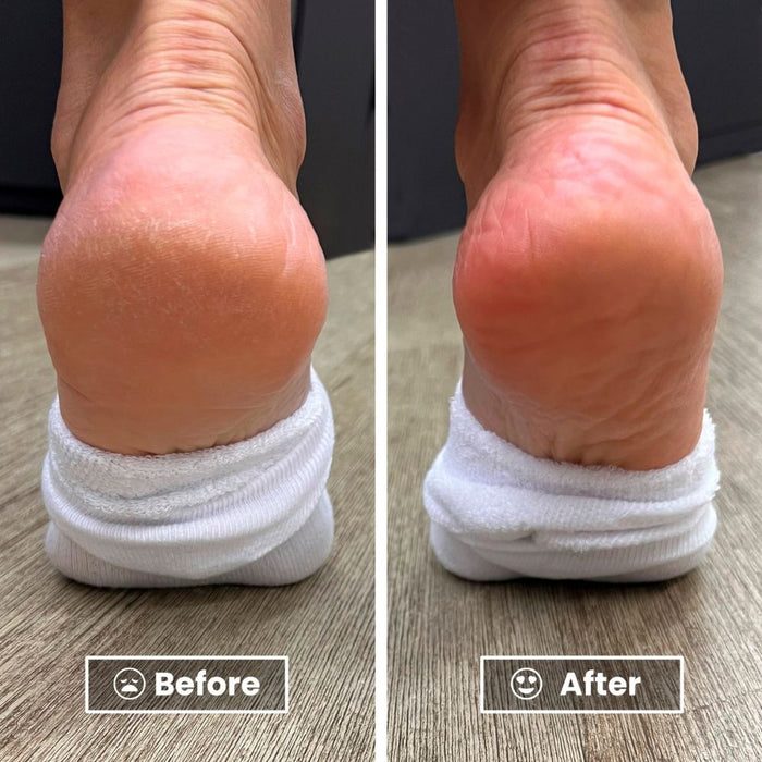 Side-by-side comparison of a heel before and after using LONDONTOWN Mini Foot Balm: the "before" heel is dry and cracked, while the "after" heel looks smoother, with softer, healthier skin.